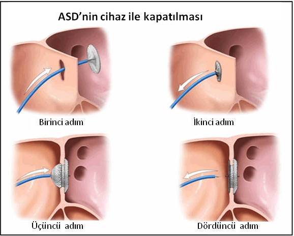 ASD KAPATILMASI.jpg